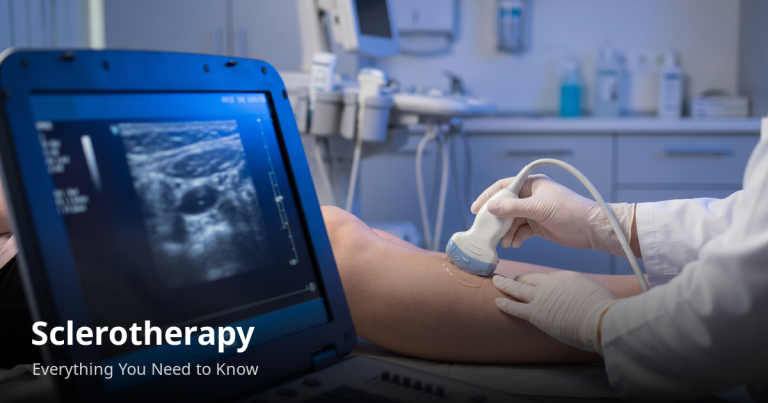 Read more about the article Sclerotherapy — Everything You Need to Know Before Treatment